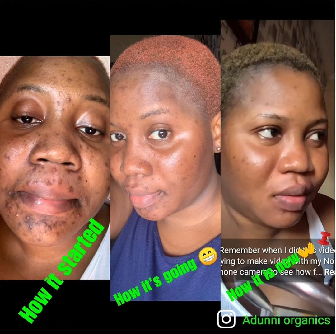 Acne Face Kit