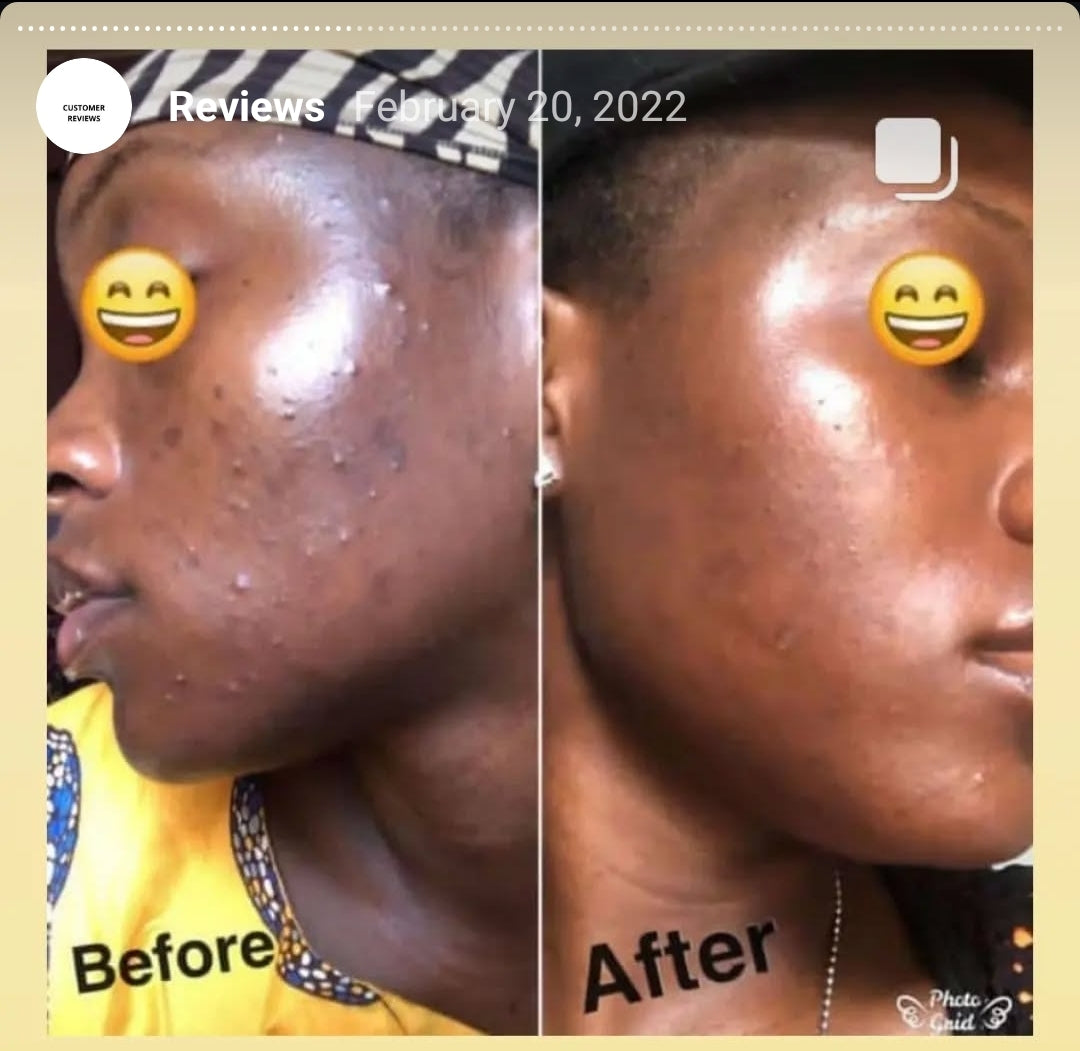 Acne Face Kit